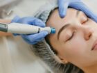 Close-up of a woman receiving a professional skin treatment with a medical-grade facial device at Jolie Beauté clinic
